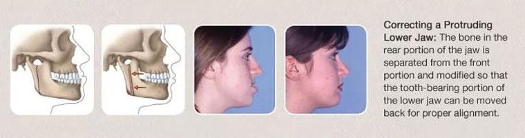 correcting a protruding lower jaw
